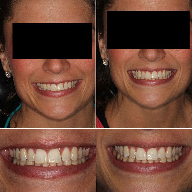 Bonding to close spaces Before and after images