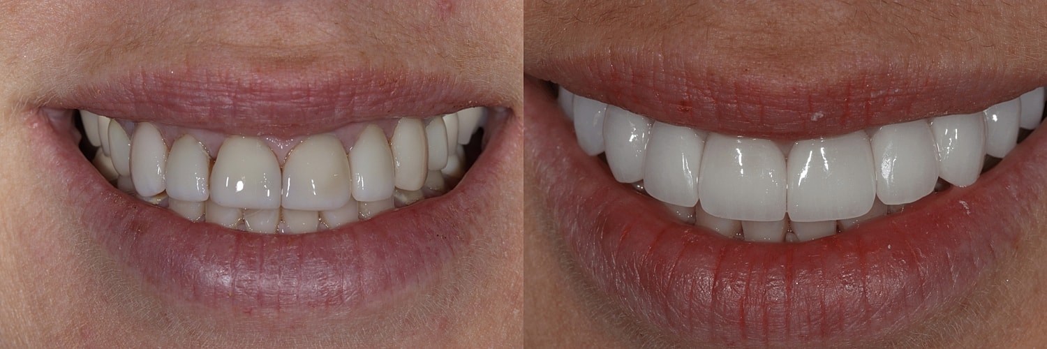 Before and after teeth whitening comparison.