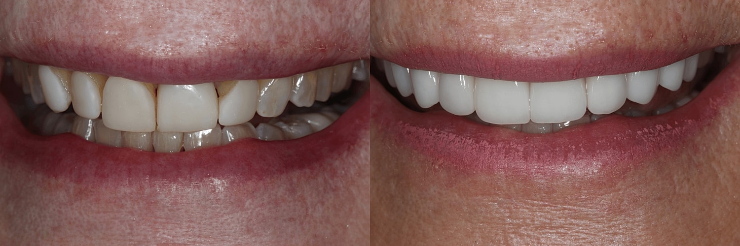 Before and after teeth whitening transformation.