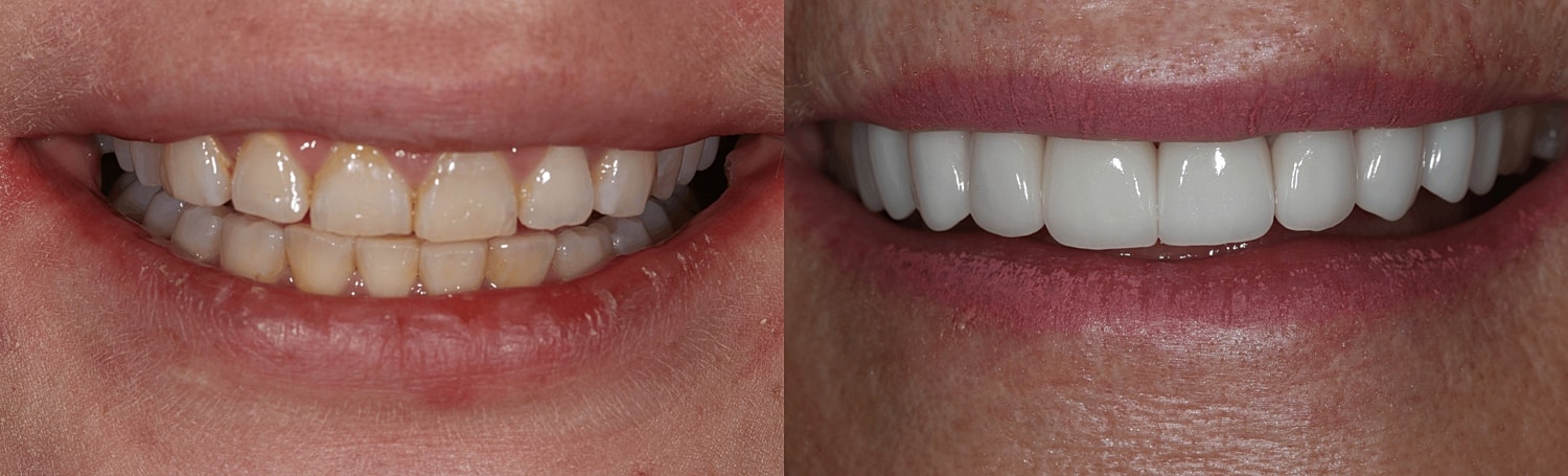 Before and after teeth whitening comparison.