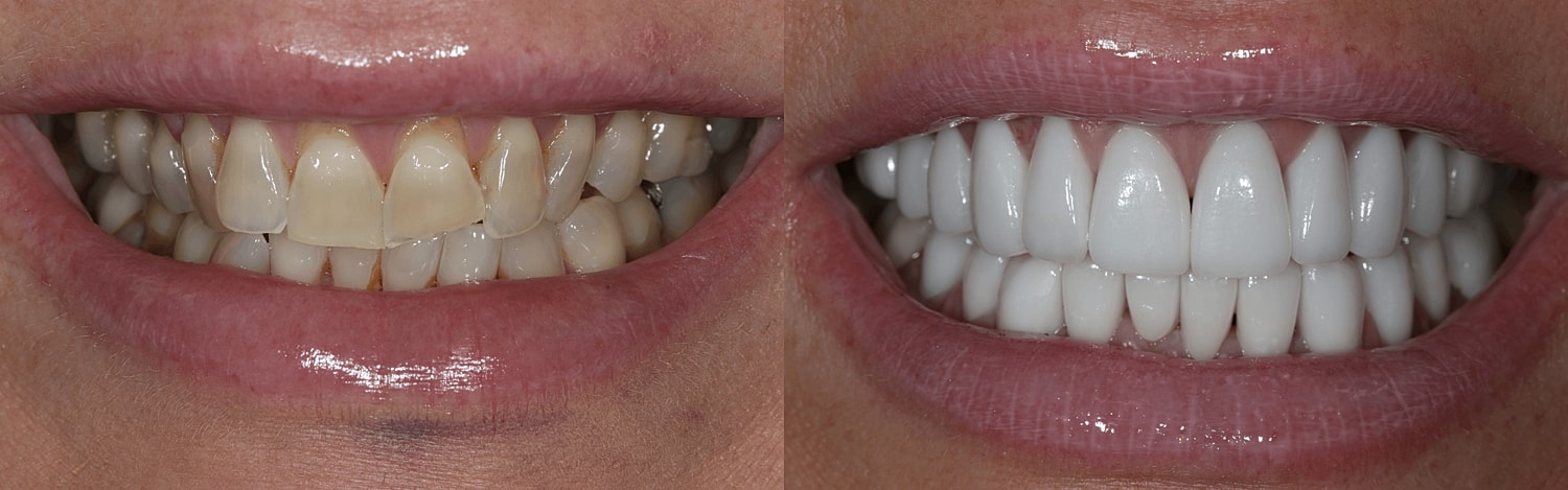 Before and after teeth whitening results.