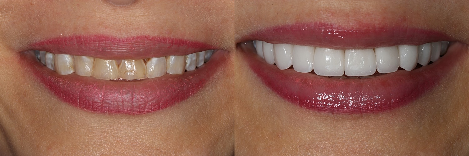 Before and after teeth whitening comparison.