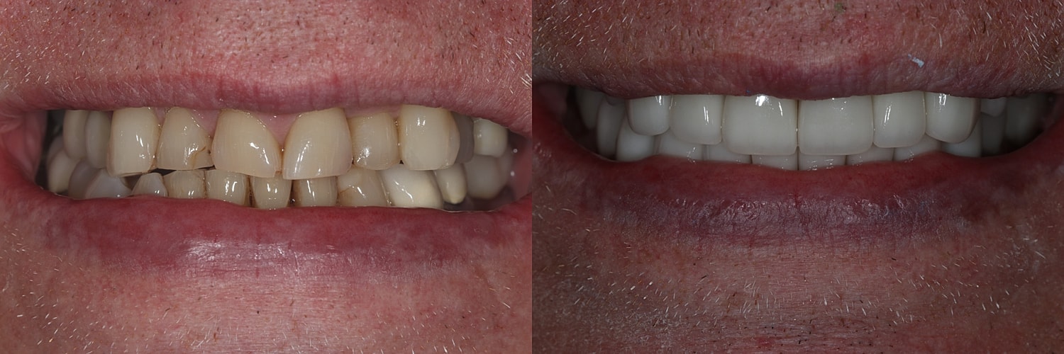Before and after dental treatment comparison.