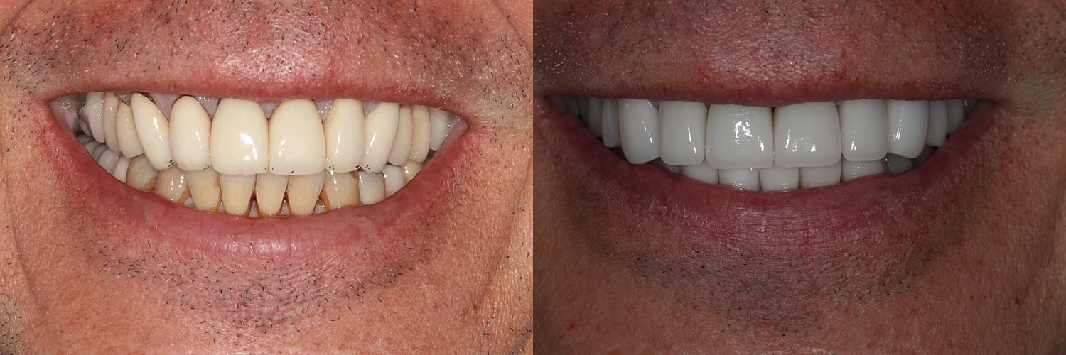 Before and after teeth whitening results.