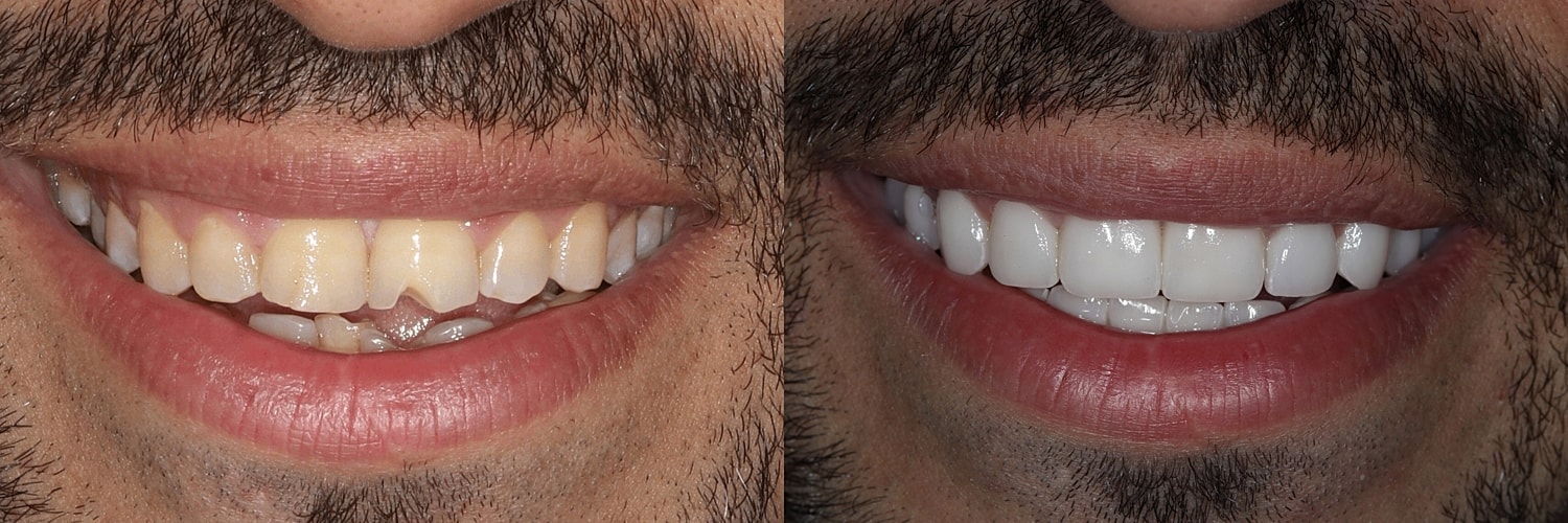 Before and after teeth whitening transformation.