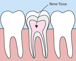 Illustration of tooth anatomy highlighting nerve tissue.