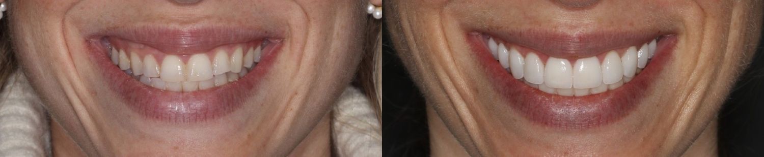 Comparison of two smiles with different appearances.