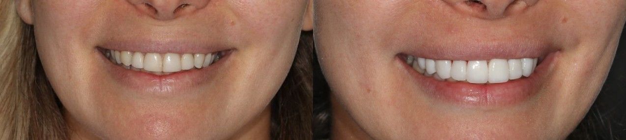 Comparison of two smiles before and after.