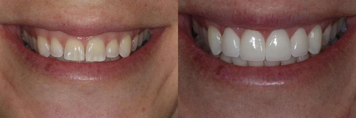 Before and after smile transformation comparison.